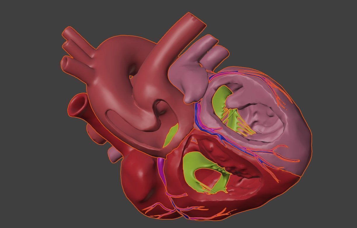 3D Model of Heart with Common Arterial Trunk Truncus Arteriosus 3D model_7