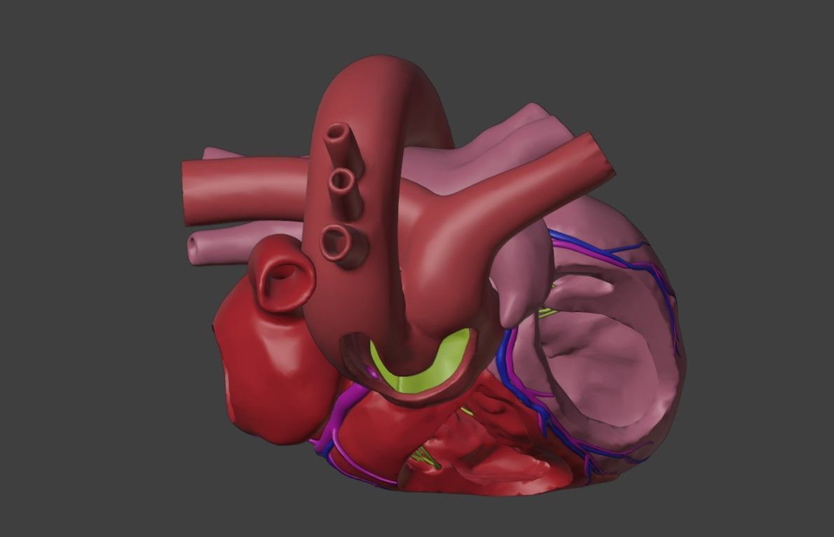 3D Model of Heart with Common Arterial Trunk Truncus Arteriosus 3D model_1
