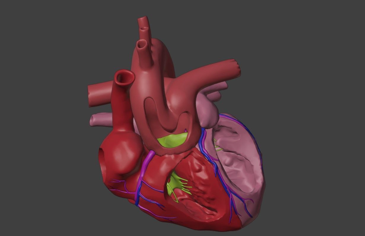 3D Model of Heart with Common Arterial Trunk Truncus Arteriosus 3D model_3