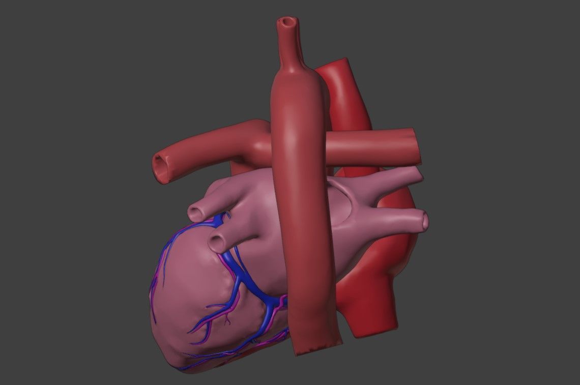 3D Model of Heart with Common Arterial Trunk Truncus Arteriosus 3D model_5