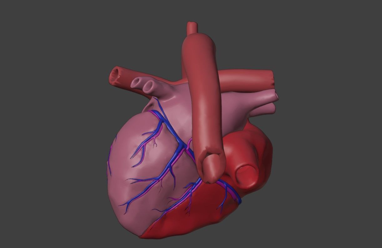 3D Model of Heart with Common Arterial Trunk Truncus Arteriosus 3D model_4