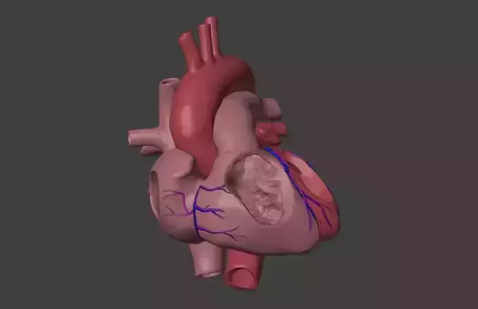 3D Model of Heart with Partial Anomalous Pulmonary Venous 