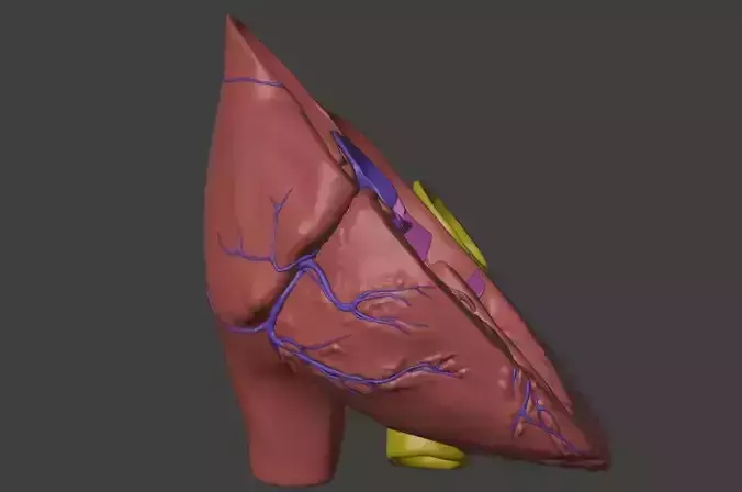 3D Model of Heart with Tetralogy of Fallot - long axis 3D model