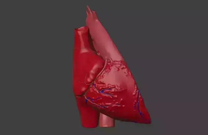  3D Model of Heart with Transposition of the Great Arteries 