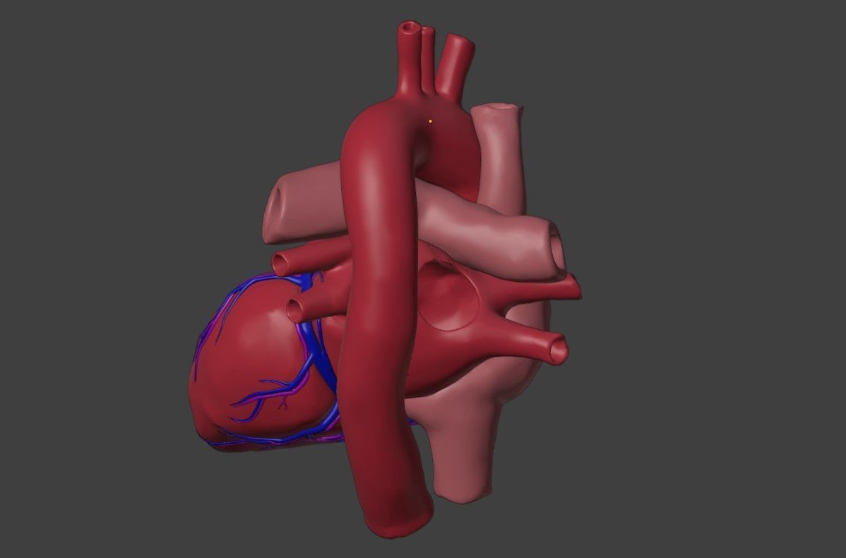 3D Model of Heart with Ventricular Septal Defect 3D model_3