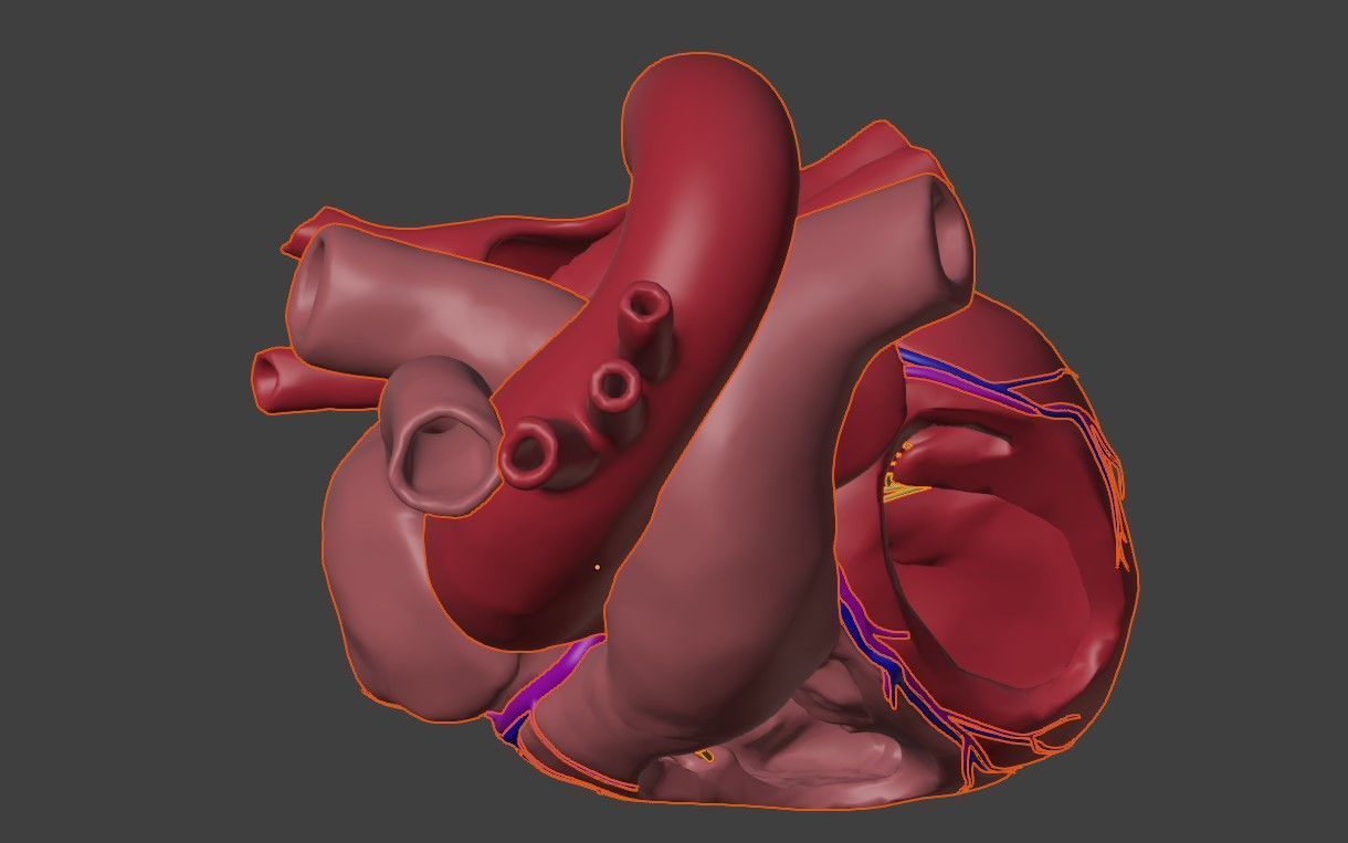 3D Model of Heart with Ventricular Septal Defect 3D model_4