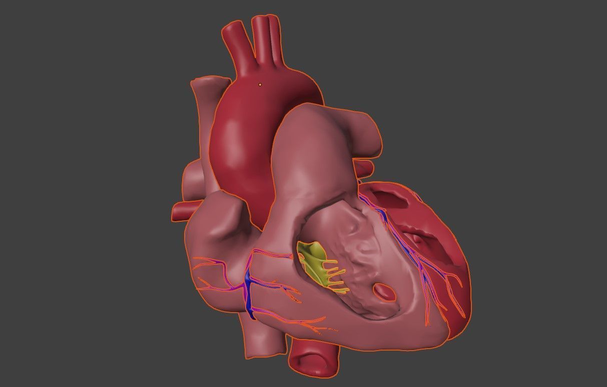 3D Model of Heart with Ventricular Septal Defect 3D model_5