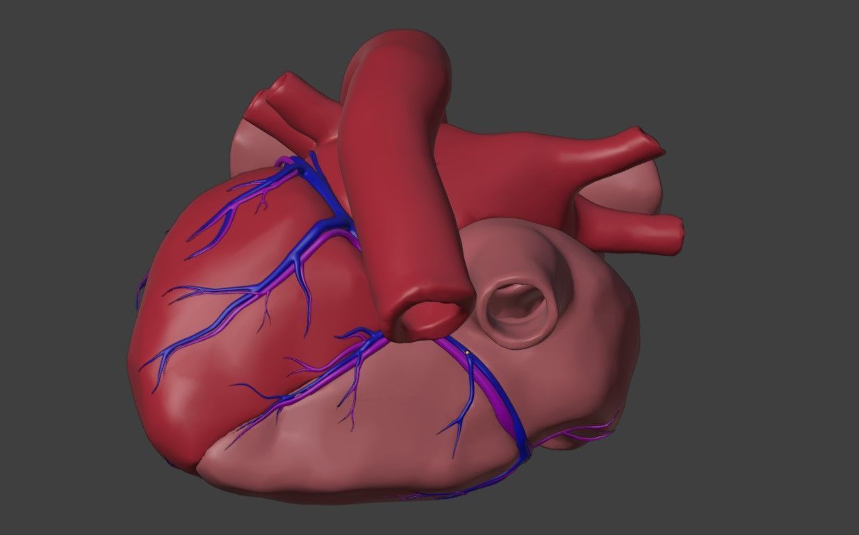 3D Model of Heart with Ventricular Septal Defect 3D model_2