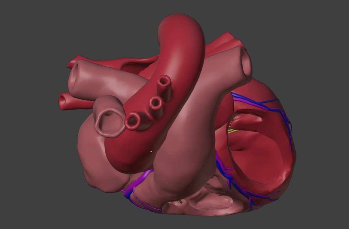 3D Model of Heart with Ventricular Septal Defect 3D model_1