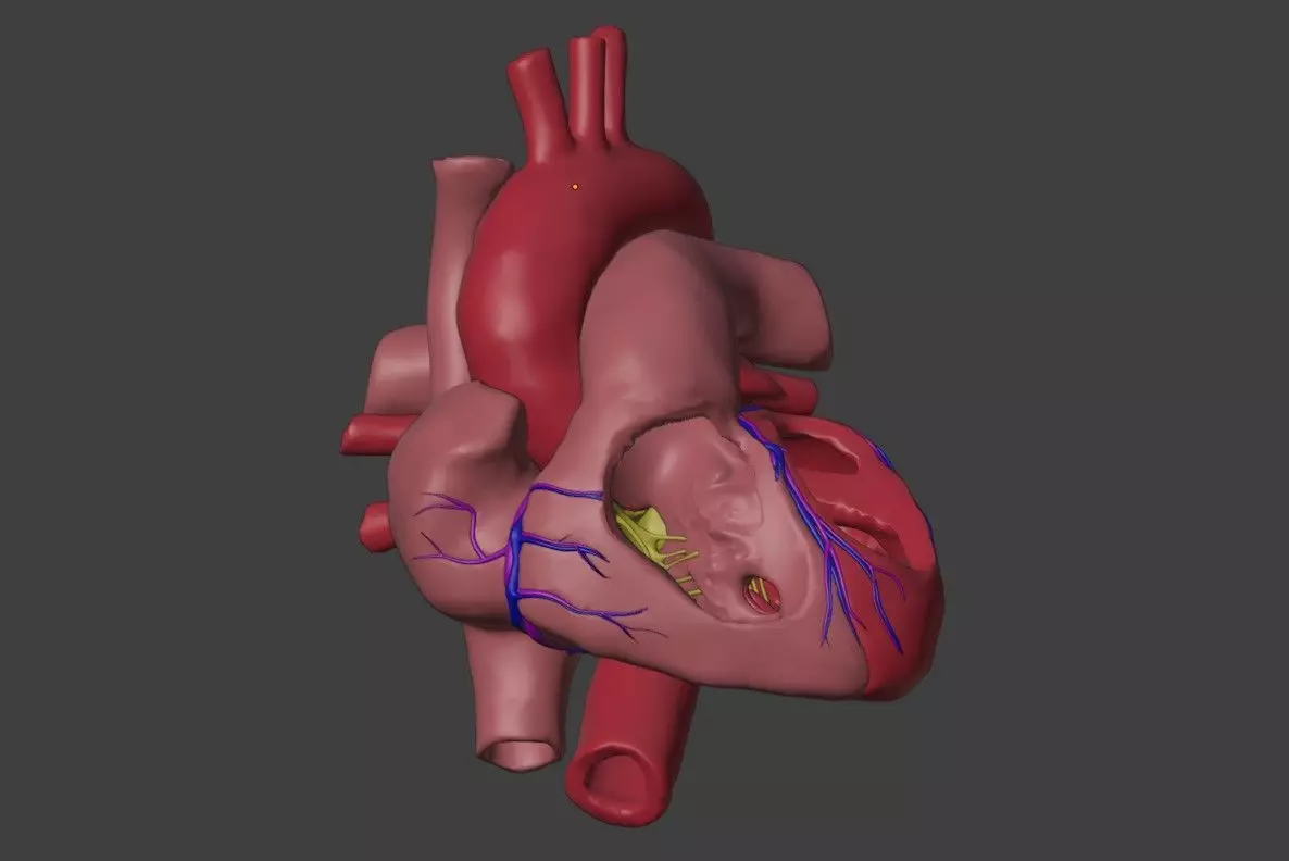 3D Model of Heart with Ventricular Septal Defect 3D model_0