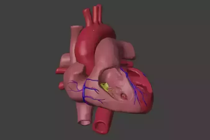 3D Model of Heart with Ventricular Septal Defect 3D model