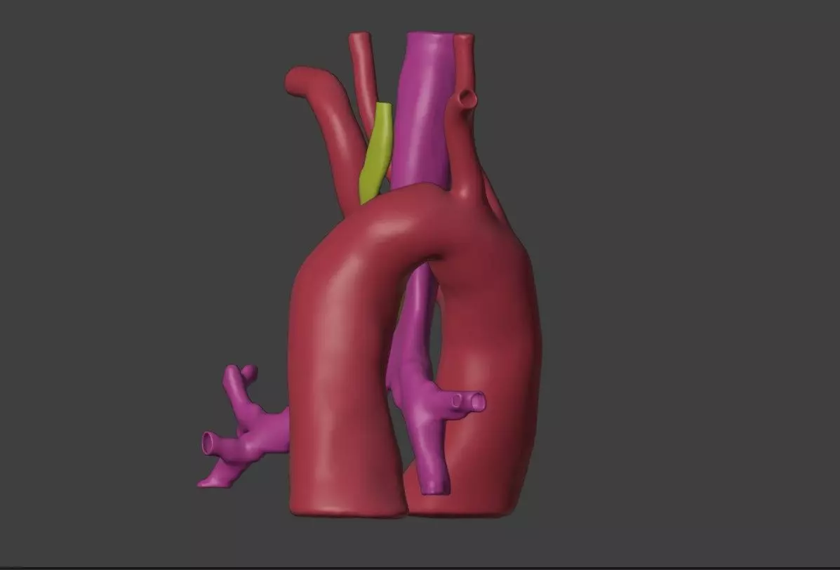 3D Model of Heart with Double Aortic Arch 3D model_0