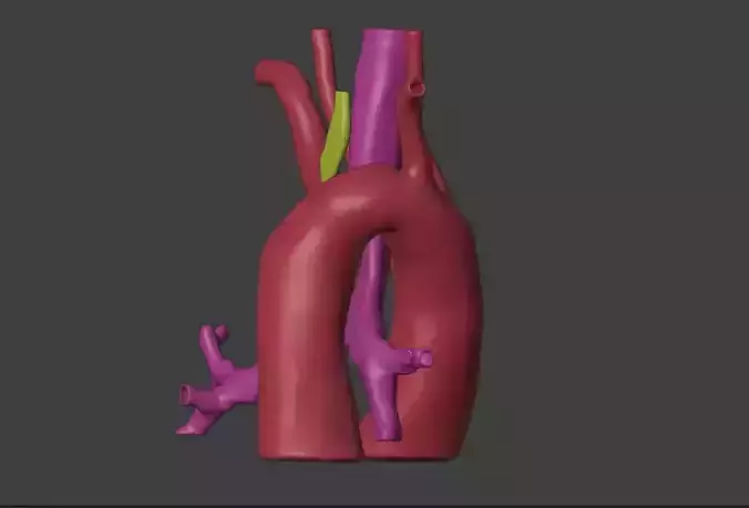 3D Model of Heart with Double Aortic Arch  