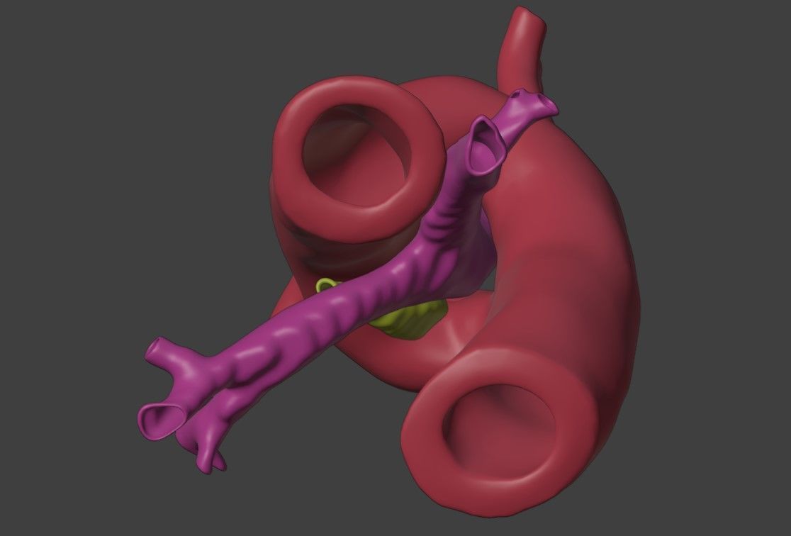 3D Model of Heart with Double Aortic Arch 3D model_5