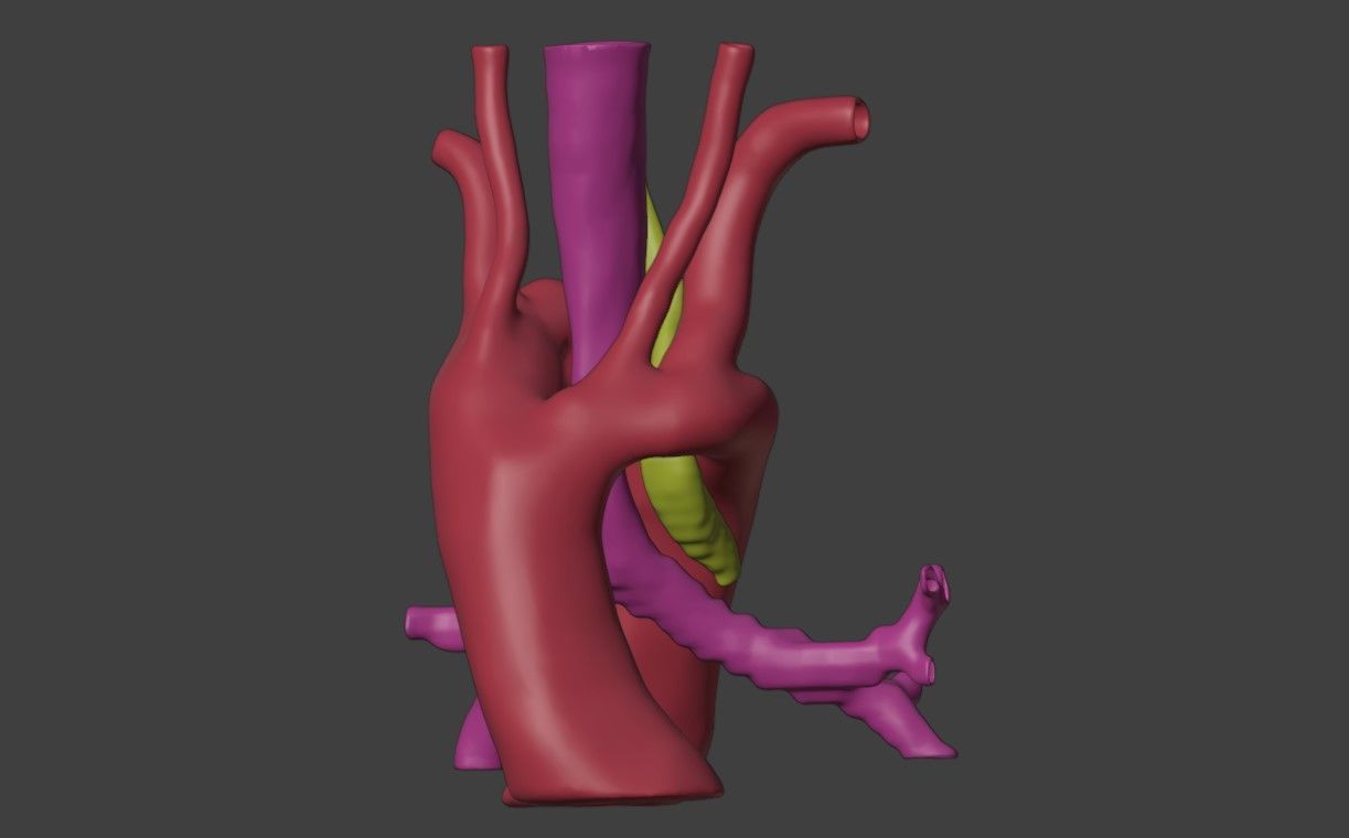 3D Model of Heart with Double Aortic Arch 3D model_2