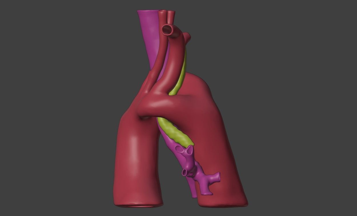 3D Model of Heart with Double Aortic Arch 3D model_3