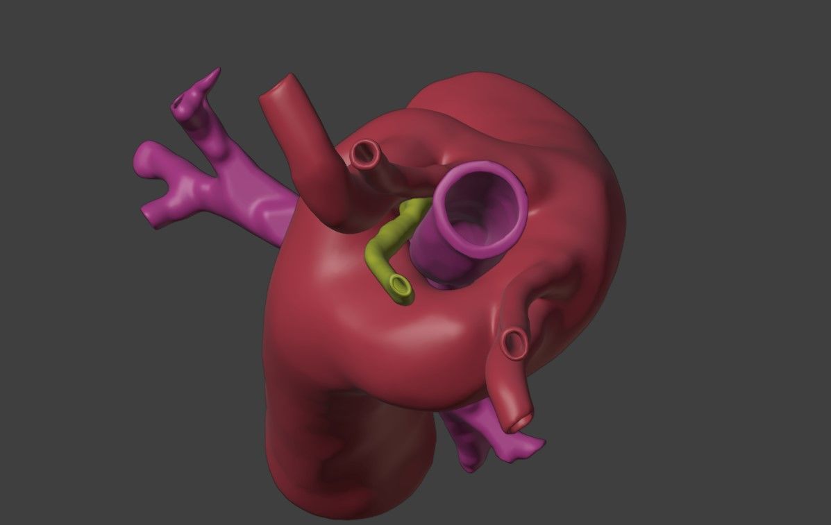 3D Model of Heart with Double Aortic Arch 3D model_4