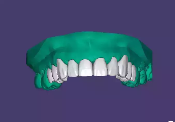 10 UPPER  dental separate crowns