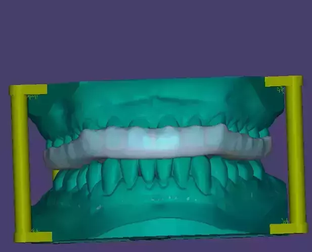  medical dental occlusal plate 