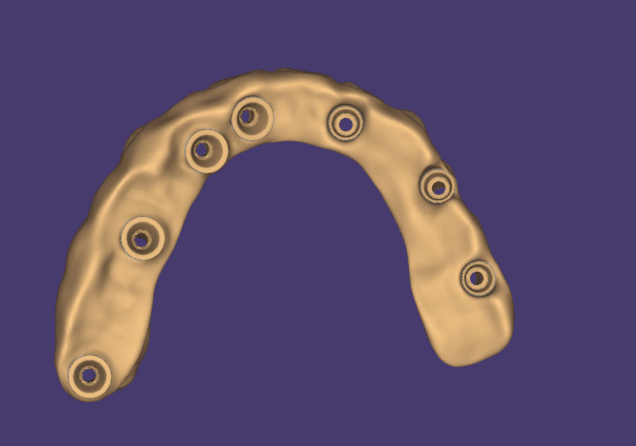  dental PRETTEAU bridge on implant PLEASE  FOLLOW  3D print model_5