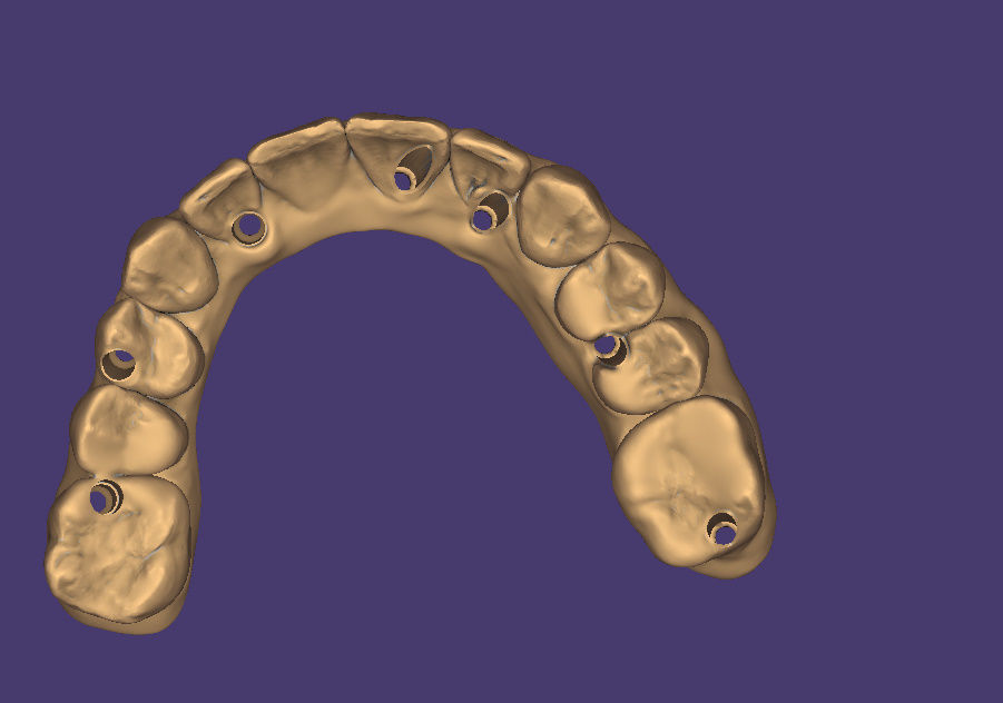  dental PRETTEAU bridge on implant PLEASE  FOLLOW  3D print model_6
