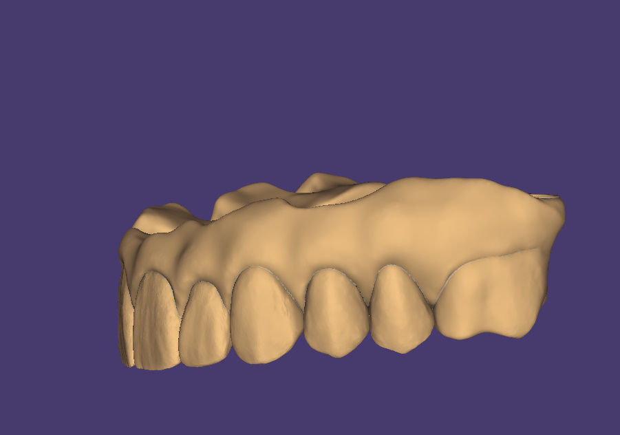 dental PRETTEAU bridge on implant PLEASE  FOLLOW  3D print model_4