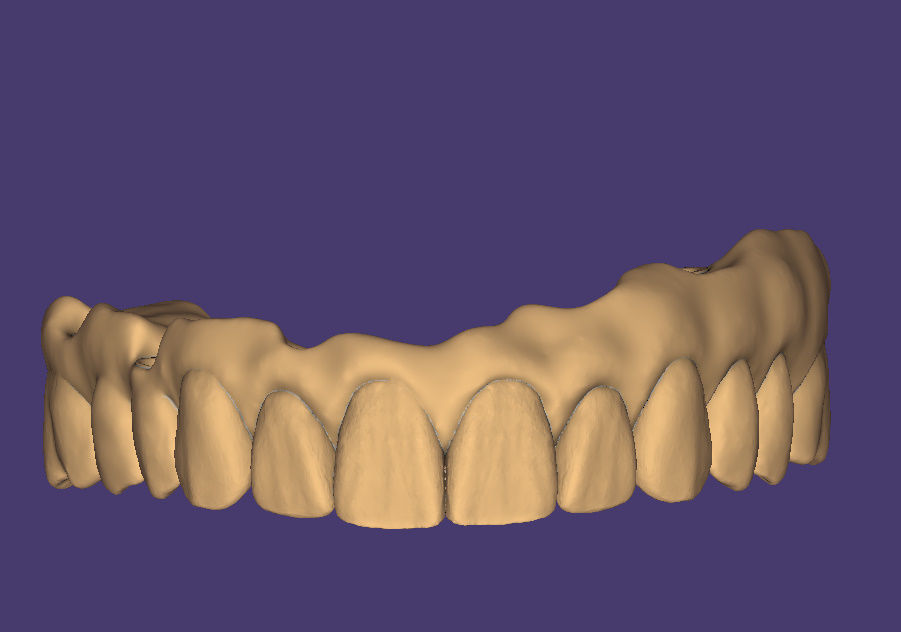  dental PRETTEAU bridge on implant PLEASE  FOLLOW  3D print model_3