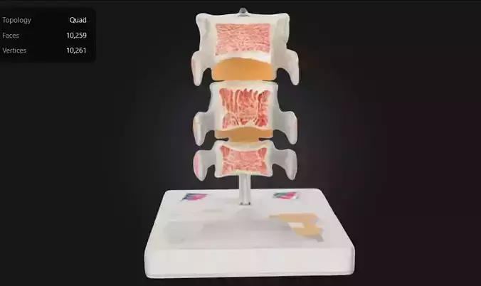3D Model of Deluxe Osteoporosis Anatomy