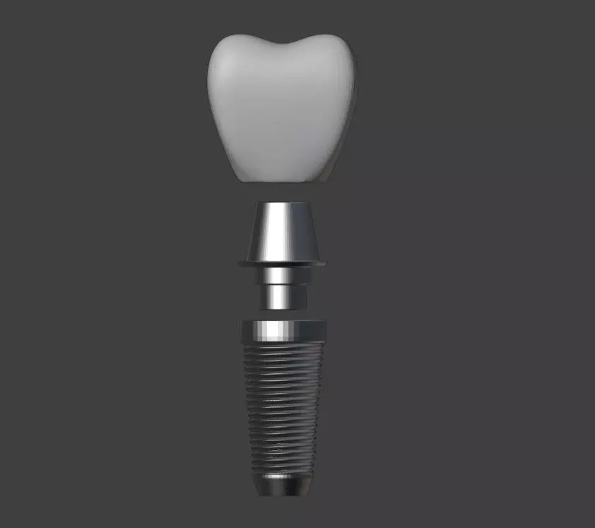  3D Model of Tooth Implant - Dental Model 3D model_0
