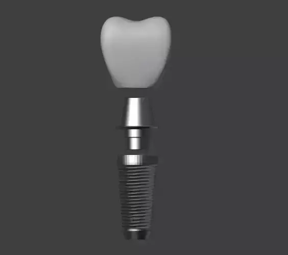  3D Model of Tooth Implant - Dental Model 3D model