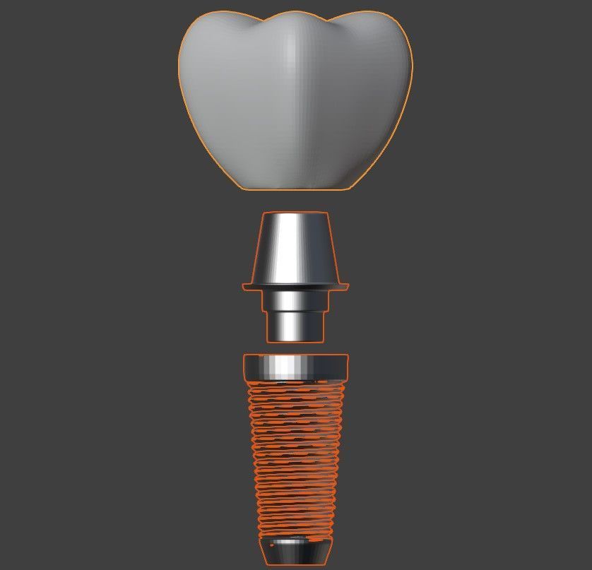  3D Model of Tooth Implant - Dental Model 3D model_3