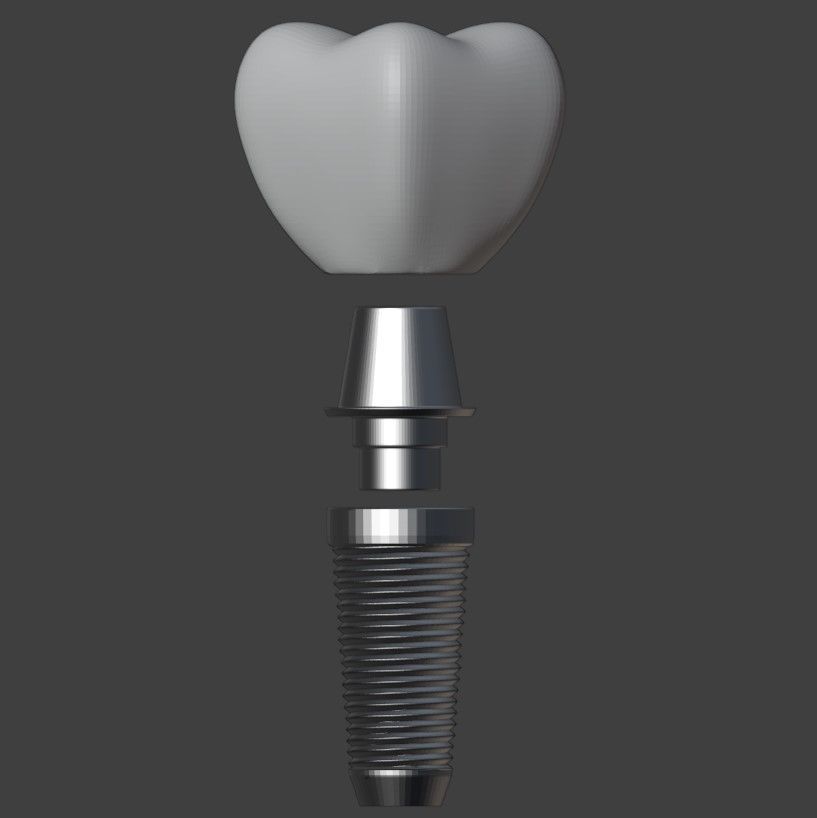  3D Model of Tooth Implant - Dental Model 3D model_4