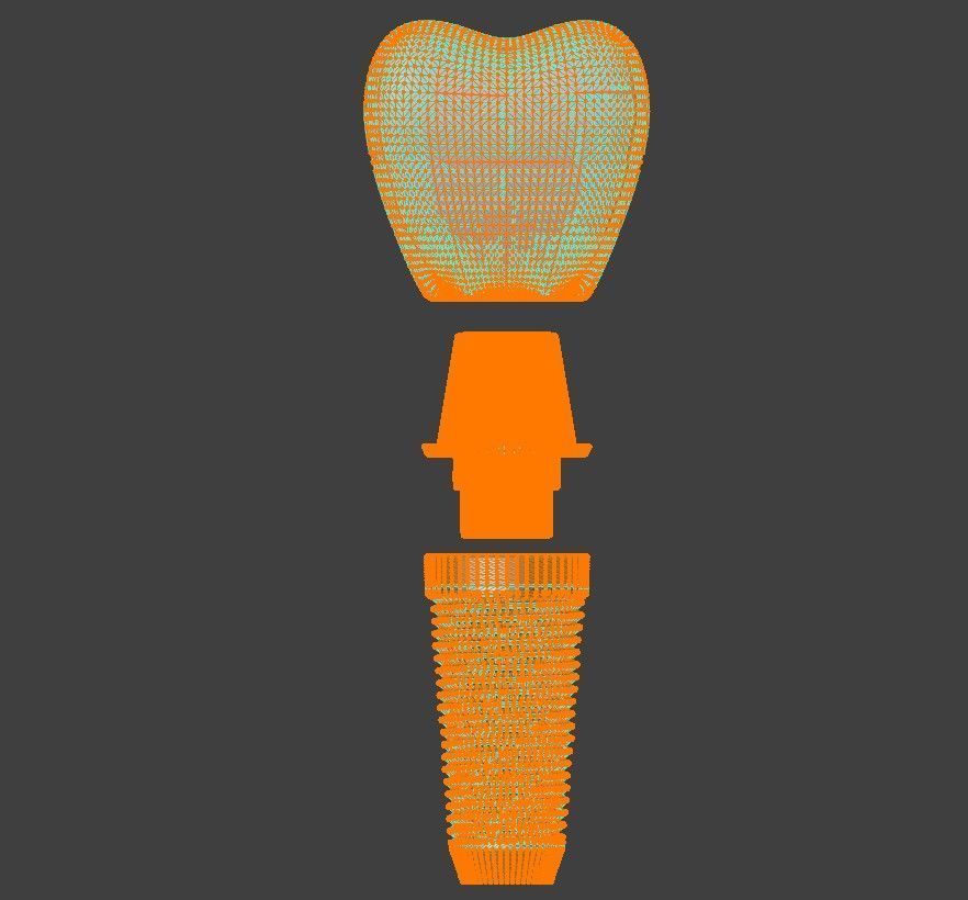  3D Model of Tooth Implant - Dental Model 3D model_2