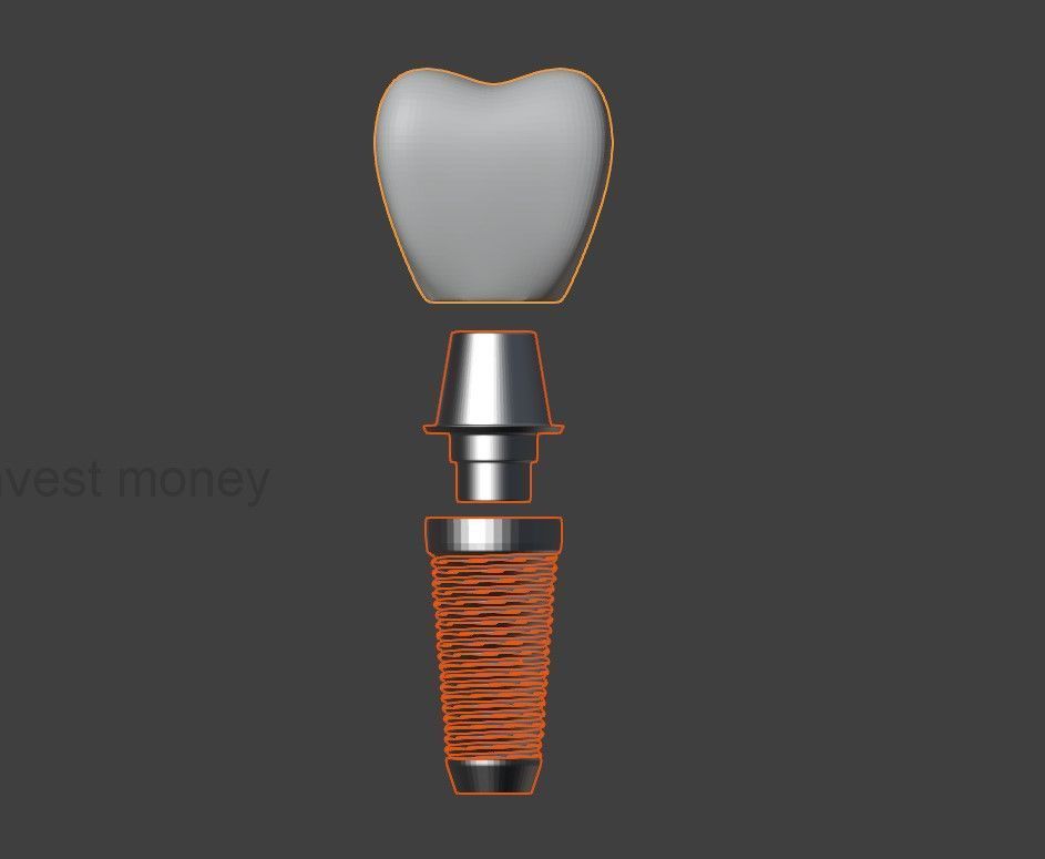  3D Model of Tooth Implant - Dental Model 3D model_1
