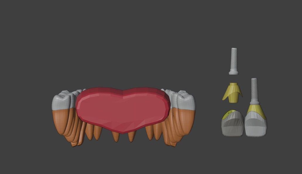 3D Model of Tooth Implants - Dental Model 3D model_5