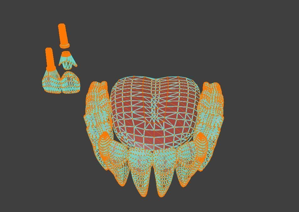 3D Model of Tooth Implants - Dental Model 3D model_4