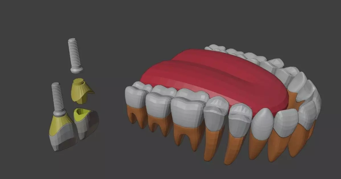 3D Model of Tooth Implants - Dental Model 3D model_0