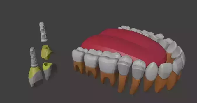 3D Model of Tooth Implants - Dental Model