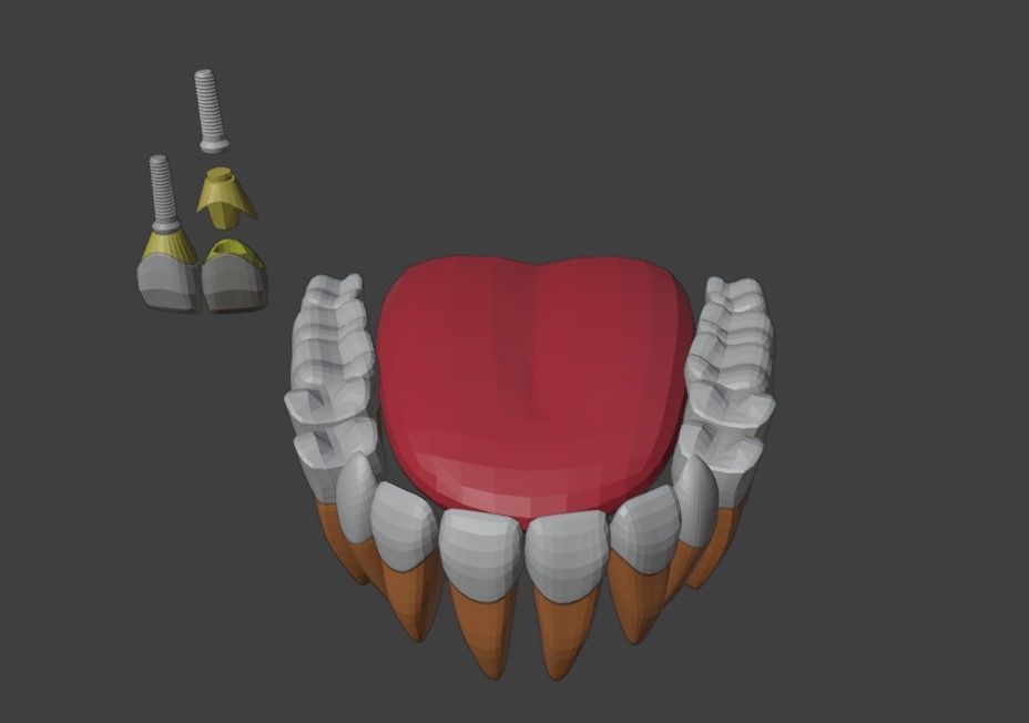 3D Model of Tooth Implants - Dental Model 3D model_2