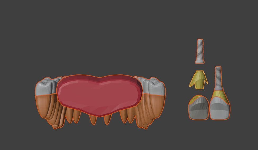 3D Model of Tooth Implants - Dental Model 3D model_6