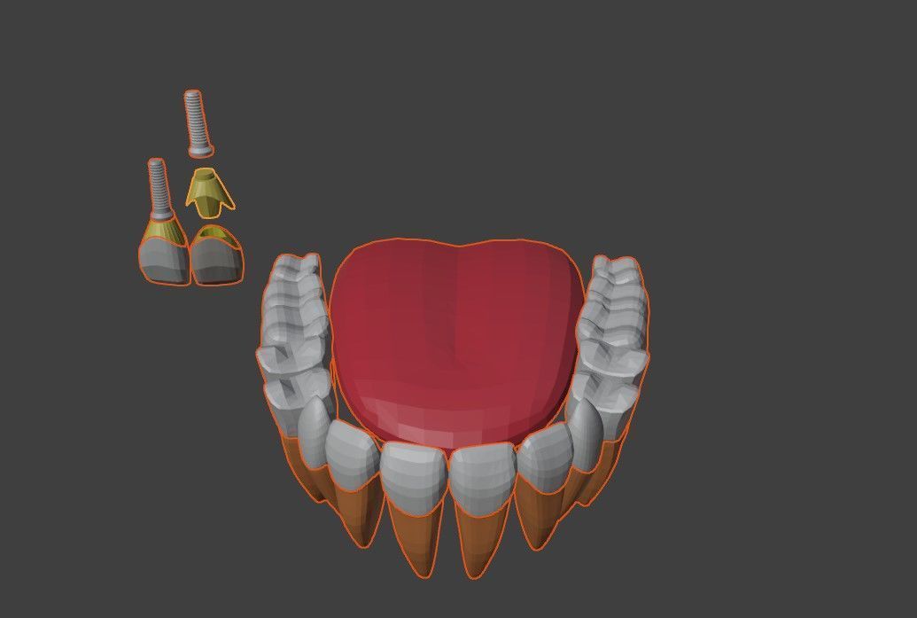 3D Model of Tooth Implants - Dental Model 3D model_3