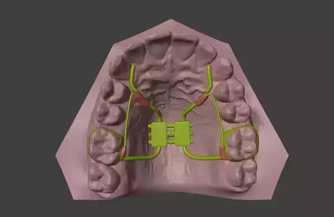 3D Model of Teeth and Rapid Palatal Expander 3D model