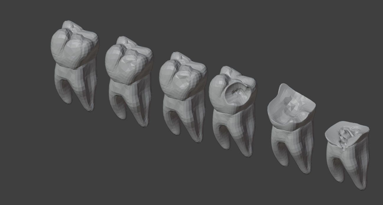 3D Model of Tooth Decay Progression - Dental Model 3D model_2