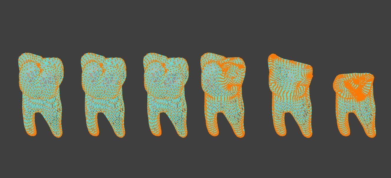 3D Model of Tooth Decay Progression - Dental Model 3D model_4