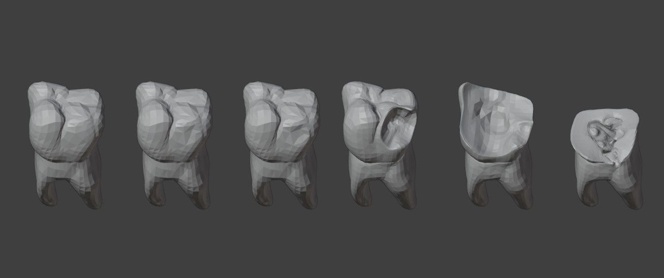 3D Model of Tooth Decay Progression - Dental Model 3D model_1