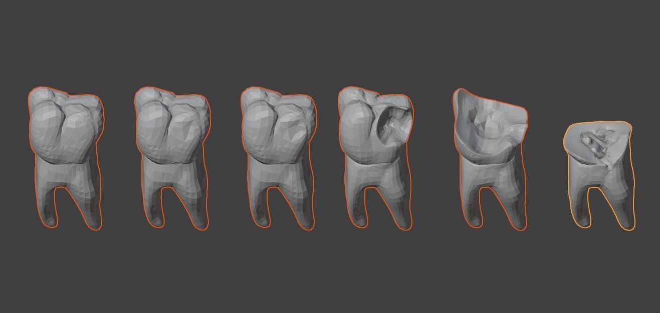 3D Model of Tooth Decay Progression - Dental Model 3D model_3