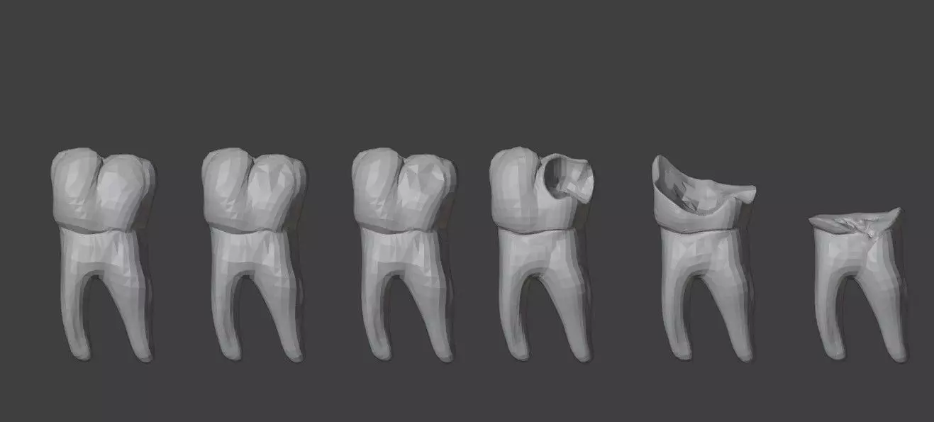 3D Model of Tooth Decay Progression - Dental Model 3D model_0