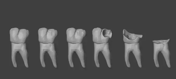 3D Model of Tooth Decay Progression - Dental Model 3D model