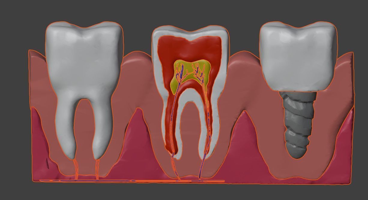 3D Dental Model - Teeth and Gum 3D print model_5