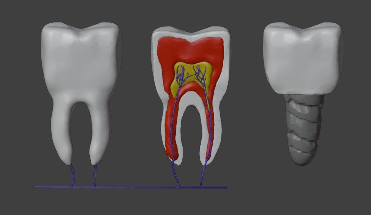 3D Dental Model - Teeth and Gum 3D print model_7